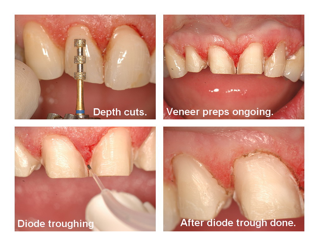 Veneers and recontouring pg6.jpg